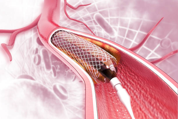 angioplasty in Kharghar best cardiologist and angioplasty